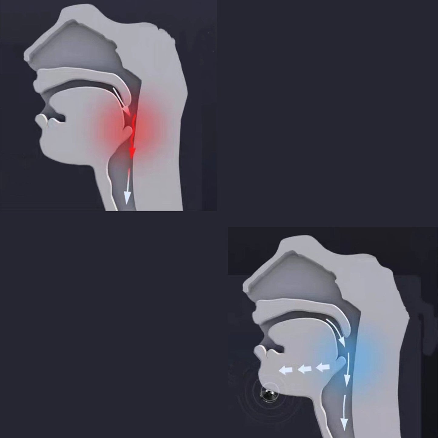 Sandsberg | Premium Anti-Schnarchgerät, für Männer und Frauen