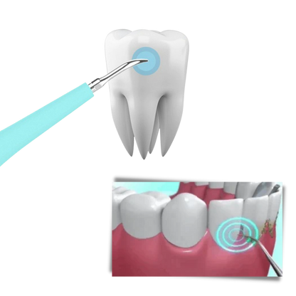 Tiefenreinigungsmaschine für Zahnstein