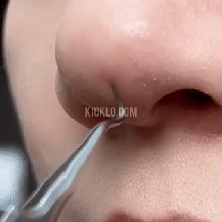 Sandsberg | Edelstahl Mitesserentferner Werkzeug - 3 Teile Set